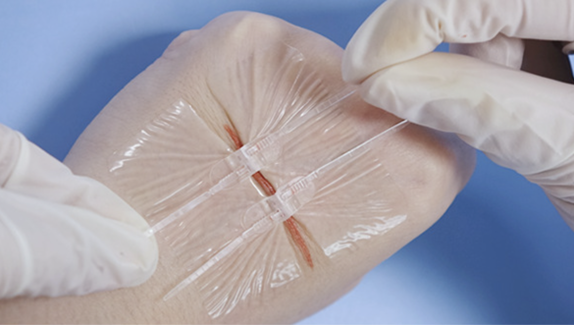 Advanced Wound Closure Model